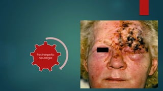 Postherpetic 
neuralgia 
 