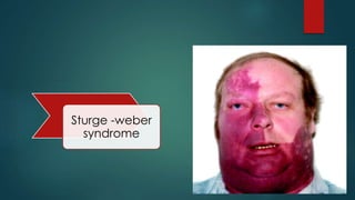 Sturge -weber 
syndrome 
 