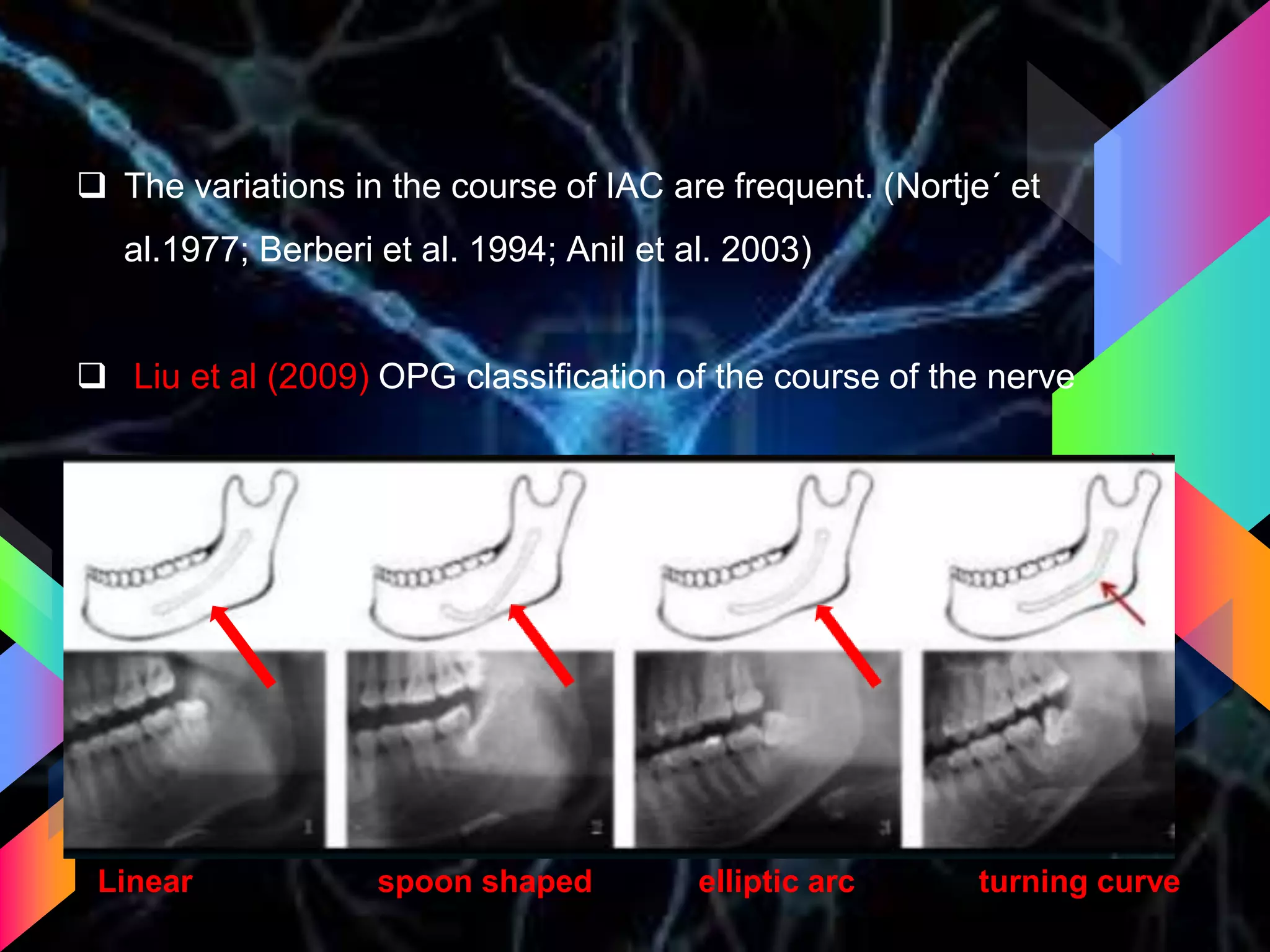  The variations in the course of IAC are frequent. (Nortje´ et
al.1977; Berberi et al. 1994; Anil et al. 2003)
 Liu et al (2009) OPG classification of the course of the nerve
Linear spoon shaped elliptic arc turning curve
 