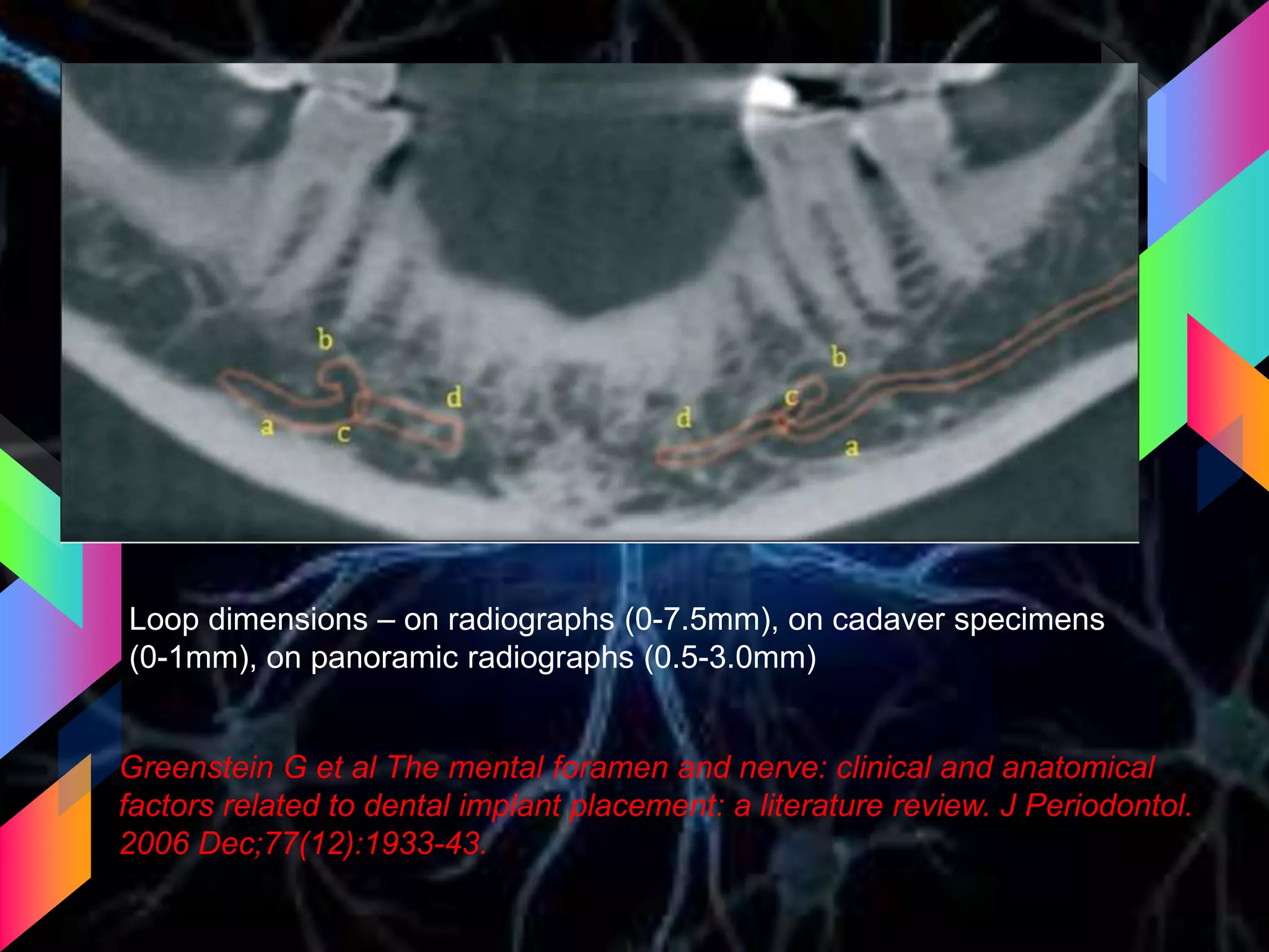 Loop dimensions – on radiographs (0-7.5mm), on cadaver specimens
(0-1mm), on panoramic radiographs (0.5-3.0mm)
Greenstein G et al The mental foramen and nerve: clinical and anatomical
factors related to dental implant placement: a literature review. J Periodontol.
2006 Dec;77(12):1933-43.
 