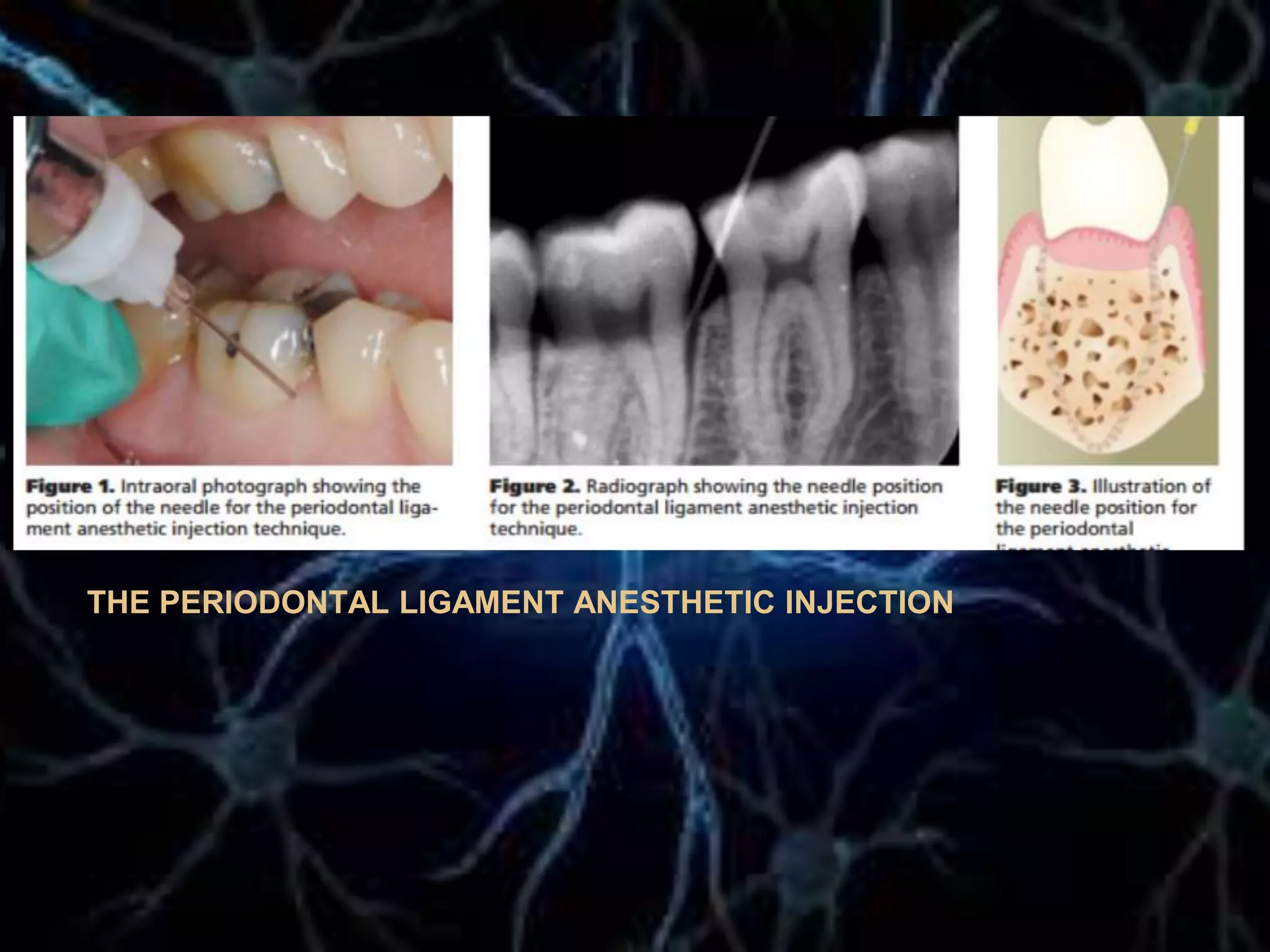 THE PERIODONTAL LIGAMENT ANESTHETIC INJECTION
 