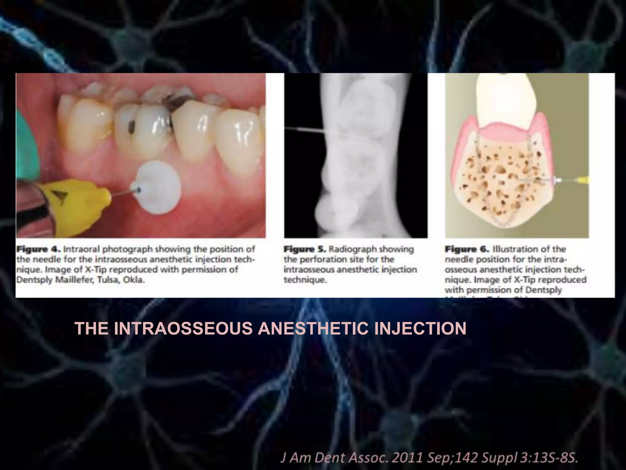 THE INTRAOSSEOUS ANESTHETIC INJECTION
 