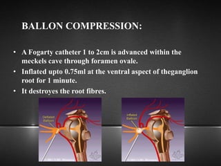 BALLON COMPRESSION:
• A Fogarty catheter 1 to 2cm is advanced within the
meckels cave through foramen ovale.
• Inflated upto 0.75ml at the ventral aspect of theganglion
root for 1 minute.
• It destroyes the root fibres.
 