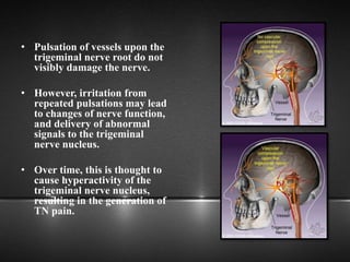• Pulsation of vessels upon the
trigeminal nerve root do not
visibly damage the nerve.
• However, irritation from
repeated pulsations may lead
to changes of nerve function,
and delivery of abnormal
signals to the trigeminal
nerve nucleus.
• Over time, this is thought to
cause hyperactivity of the
trigeminal nerve nucleus,
resulting in the generation of
TN pain.
 