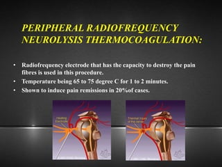 PERIPHERAL RADIOFREQUENCY
NEUROLYSIS THERMOCOAGULATION:
• Radiofrequency electrode that has the capacity to destroy the pain
fibres is used in this procedure.
• Temperature being 65 to 75 degree C for 1 to 2 minutes.
• Shown to induce pain remissions in 20%of cases.
 
