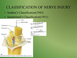 CLASSIFICATION OF NERVE INJURY
• Seddon’s Classification(1943)
• Sunderland’s Classification(1951)
 