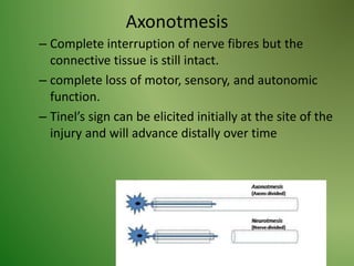 Axonotmesis
– Complete interruption of nerve fibres but the
connective tissue is still intact.
– complete loss of motor, sensory, and autonomic
function.
– Tinel’s sign can be elicited initially at the site of the
injury and will advance distally over time
 
