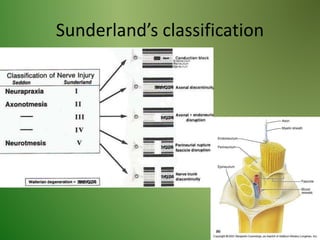 Sunderland’s classification
 