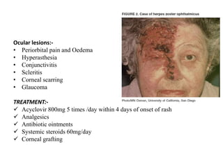 Ocular lesions:-
• Periorbital pain and Oedema
• Hyperasthesia
• Conjunctivitis
• Scleritis
• Corneal scarring
• Glaucoma
TREATMENT:-
 Acyclovir 800mg 5 times /day within 4 days of onset of rash
 Analgesics
 Antibiotic ointments
 Systemic steroids 60mg/day
 Corneal grafting
 