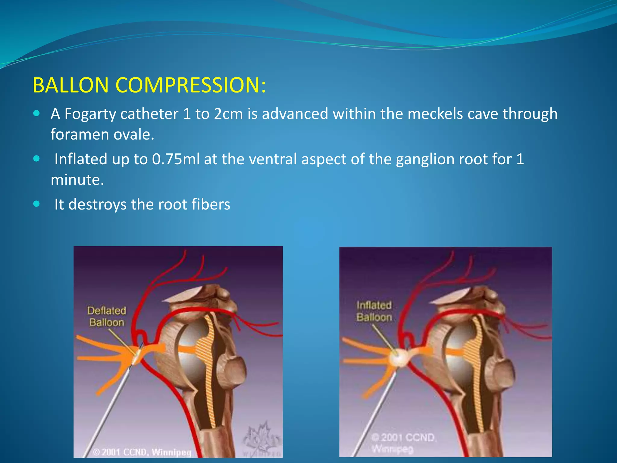 BALLON COMPRESSION:
 A Fogarty catheter 1 to 2cm is advanced within the meckels cave through
foramen ovale.
 Inflated up to 0.75ml at the ventral aspect of the ganglion root for 1
minute.
 It destroys the root fibers
 