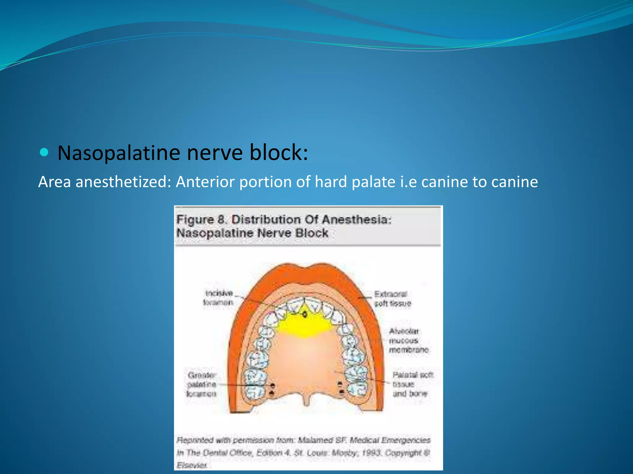  Nasopalatine nerve block:
Area anesthetized: Anterior portion of hard palate i.e canine to canine
 