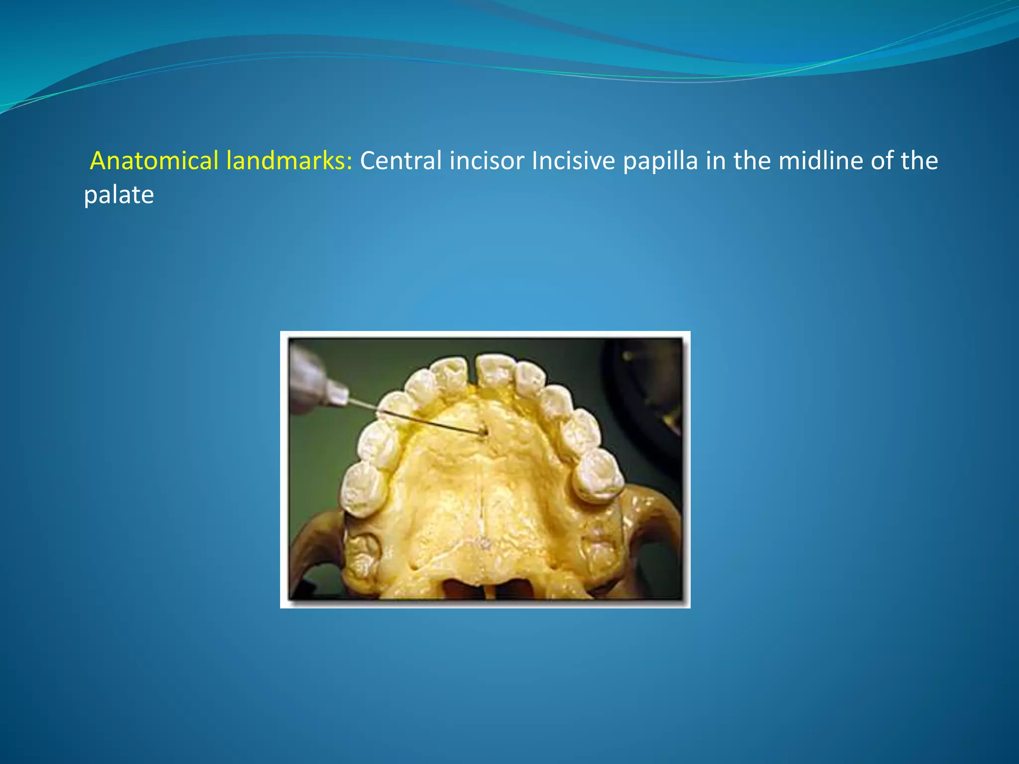 Anatomical landmarks: Central incisor Incisive papilla in the midline of the
palate
 