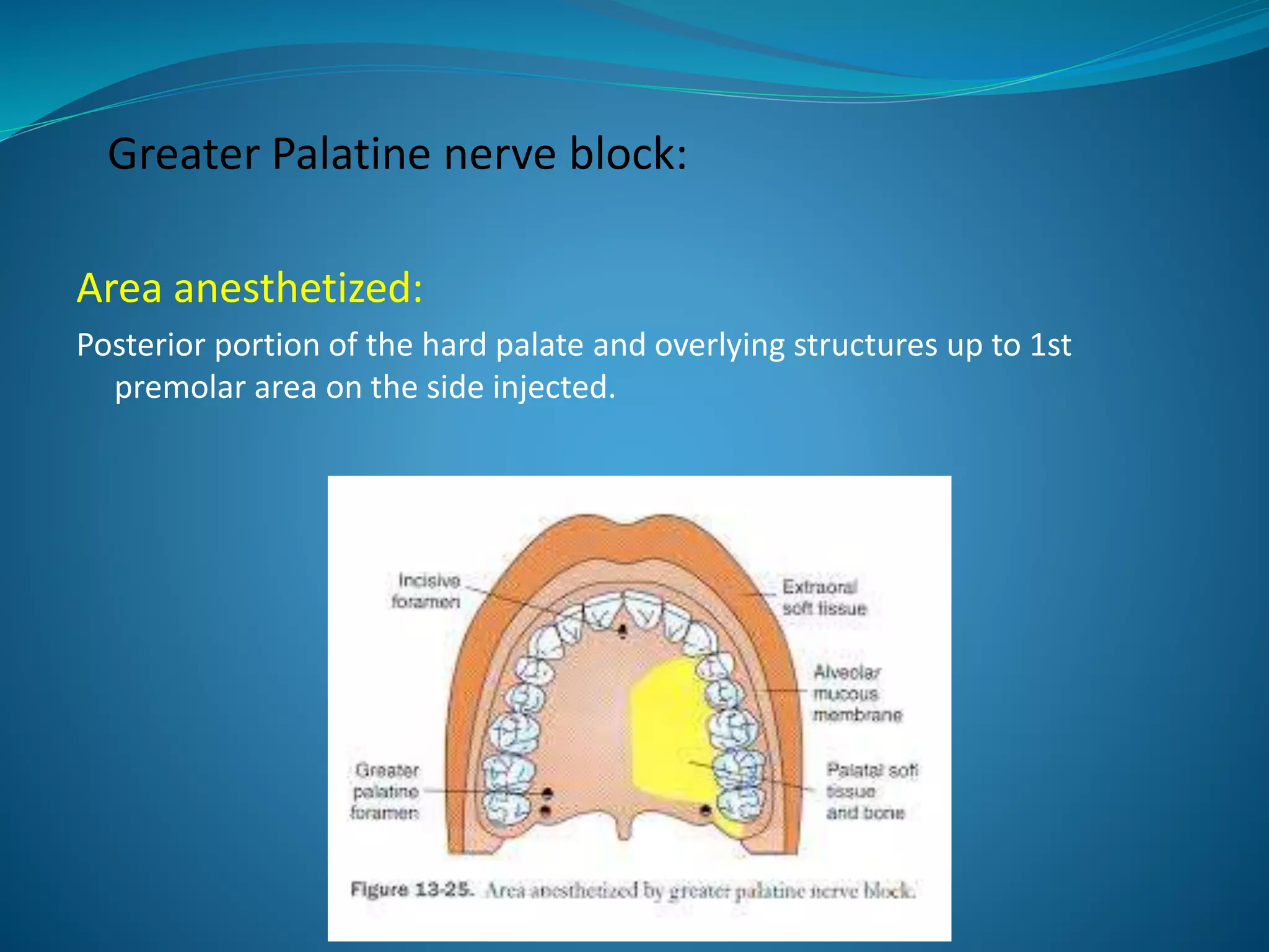 Greater Palatine nerve block:
Area anesthetized:
Posterior portion of the hard palate and overlying structures up to 1st
premolar area on the side injected.
 