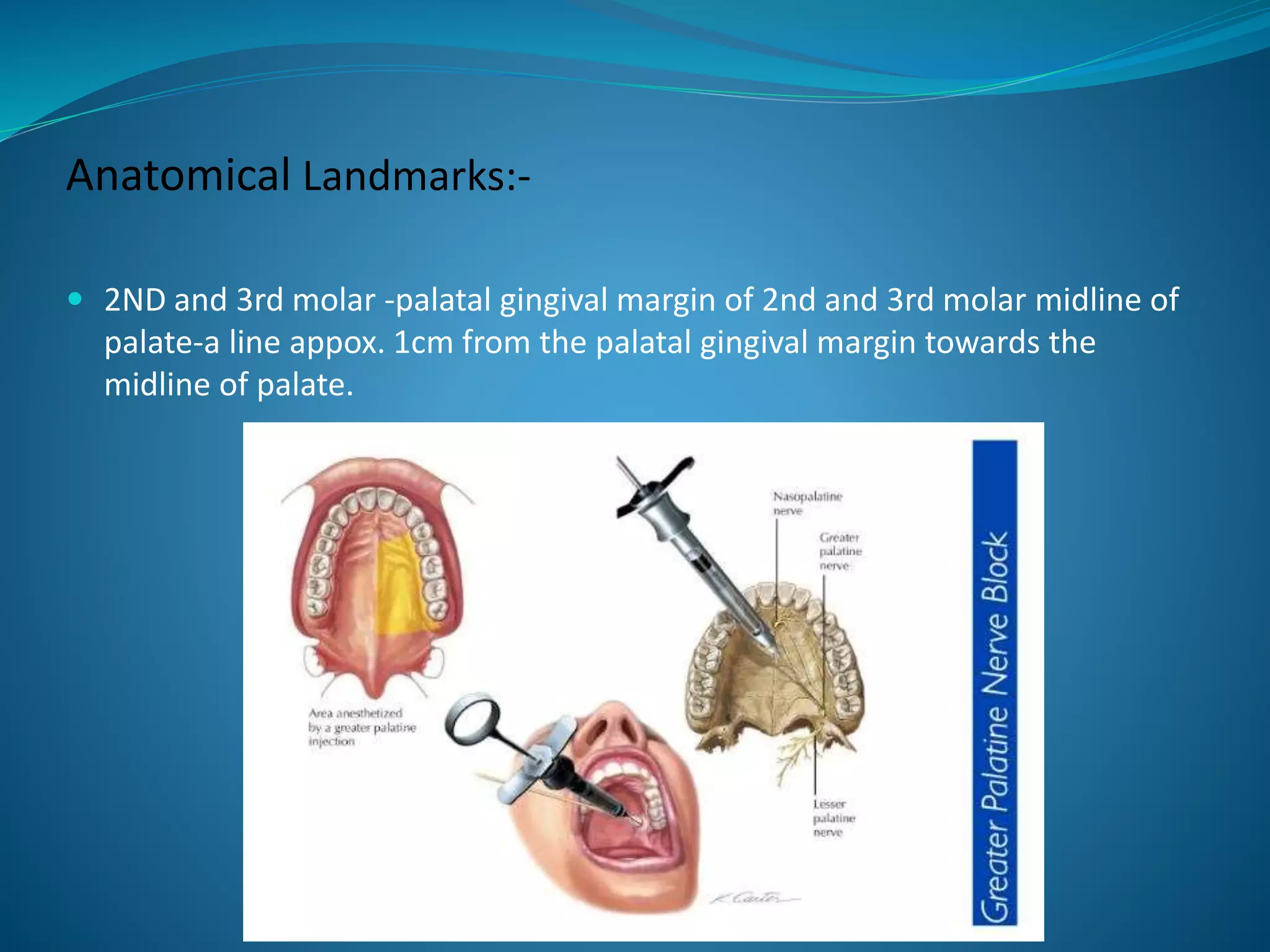 Anatomical Landmarks:-
 2ND and 3rd molar -palatal gingival margin of 2nd and 3rd molar midline of
palate-a line appox. 1cm from the palatal gingival margin towards the
midline of palate.
 