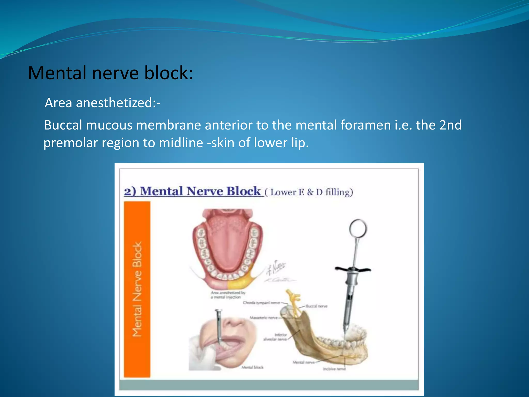 Mental nerve block:
Area anesthetized:-
Buccal mucous membrane anterior to the mental foramen i.e. the 2nd
premolar region to midline -skin of lower lip.
 