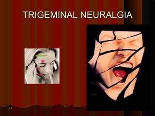 TRIGEMINAL NEURALGIATRIGEMINAL NEURALGIA
7474
 