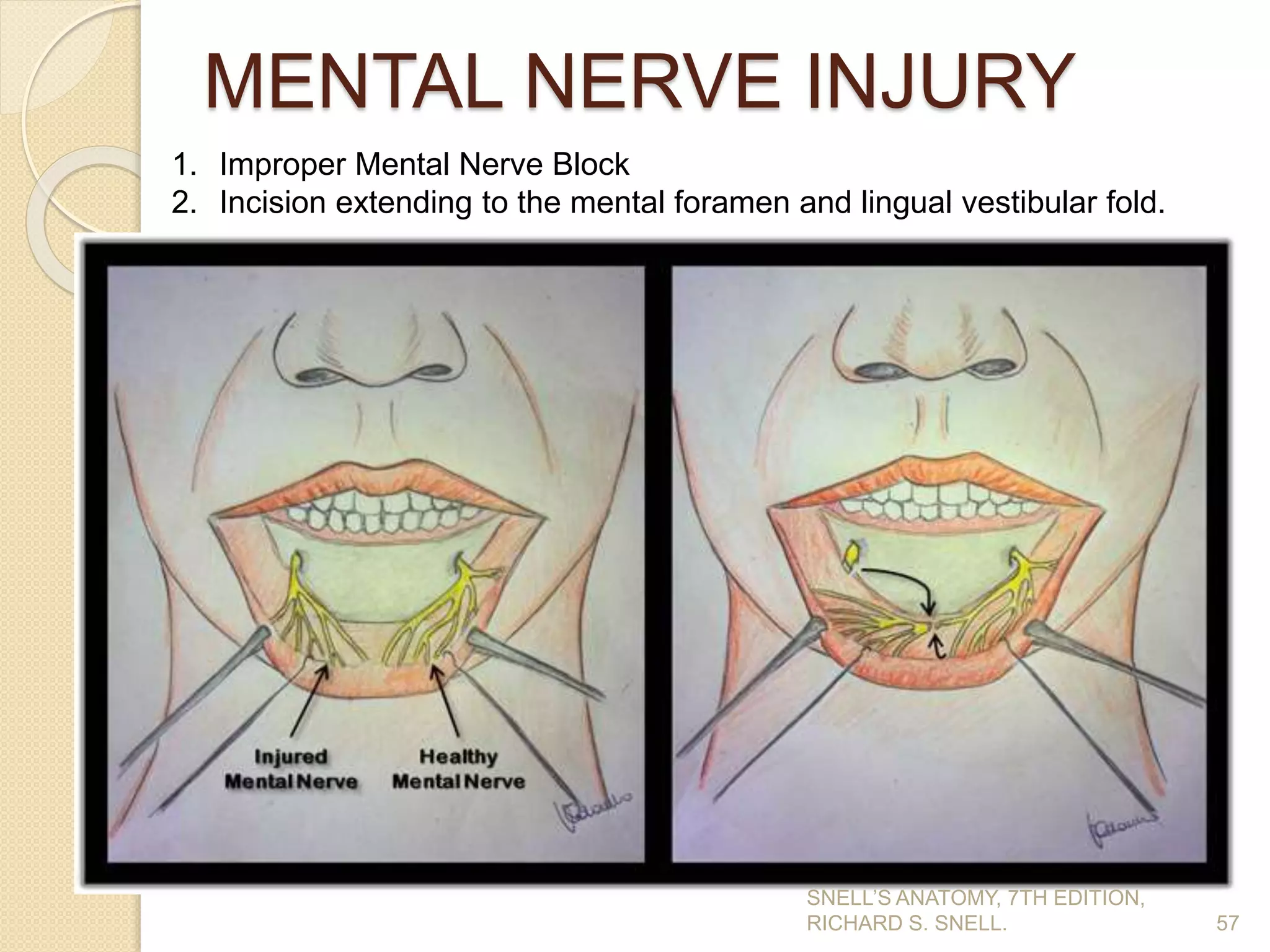 MENTAL NERVE INJURY
57
1. Improper Mental Nerve Block
2. Incision extending to the mental foramen and lingual vestibular fold.
SNELL’S ANATOMY, 7TH EDITION,
RICHARD S. SNELL.
 