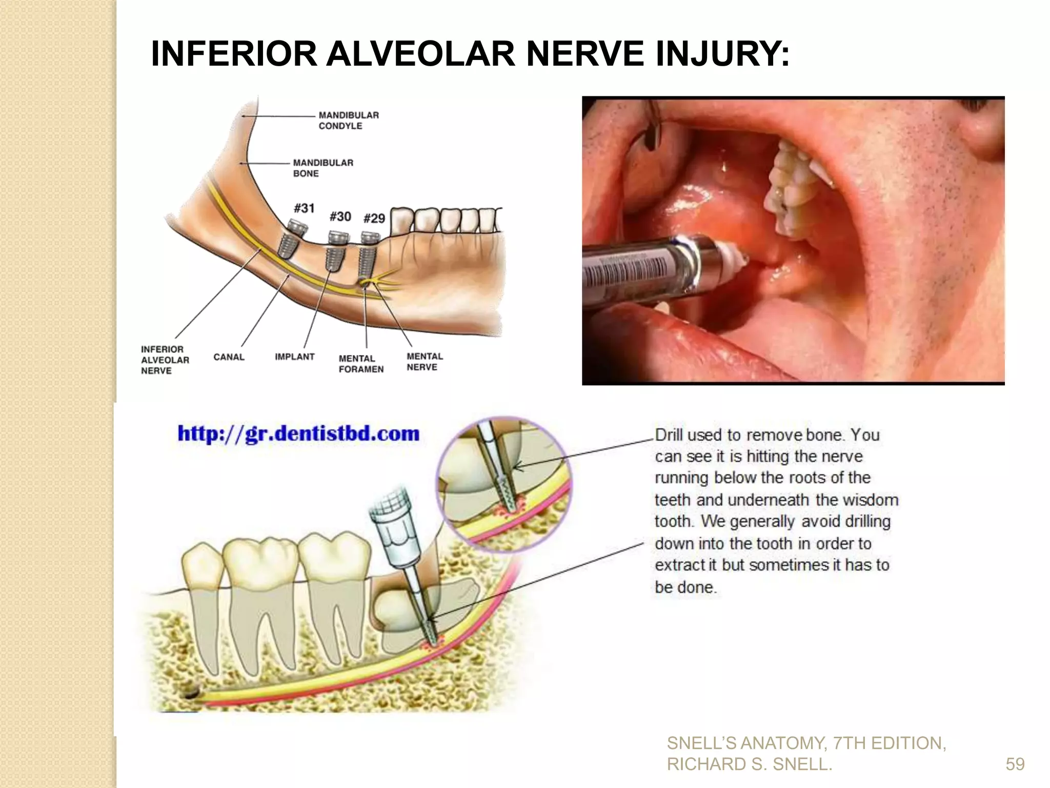 59
INFERIOR ALVEOLAR NERVE INJURY:
SNELL’S ANATOMY, 7TH EDITION,
RICHARD S. SNELL.
 