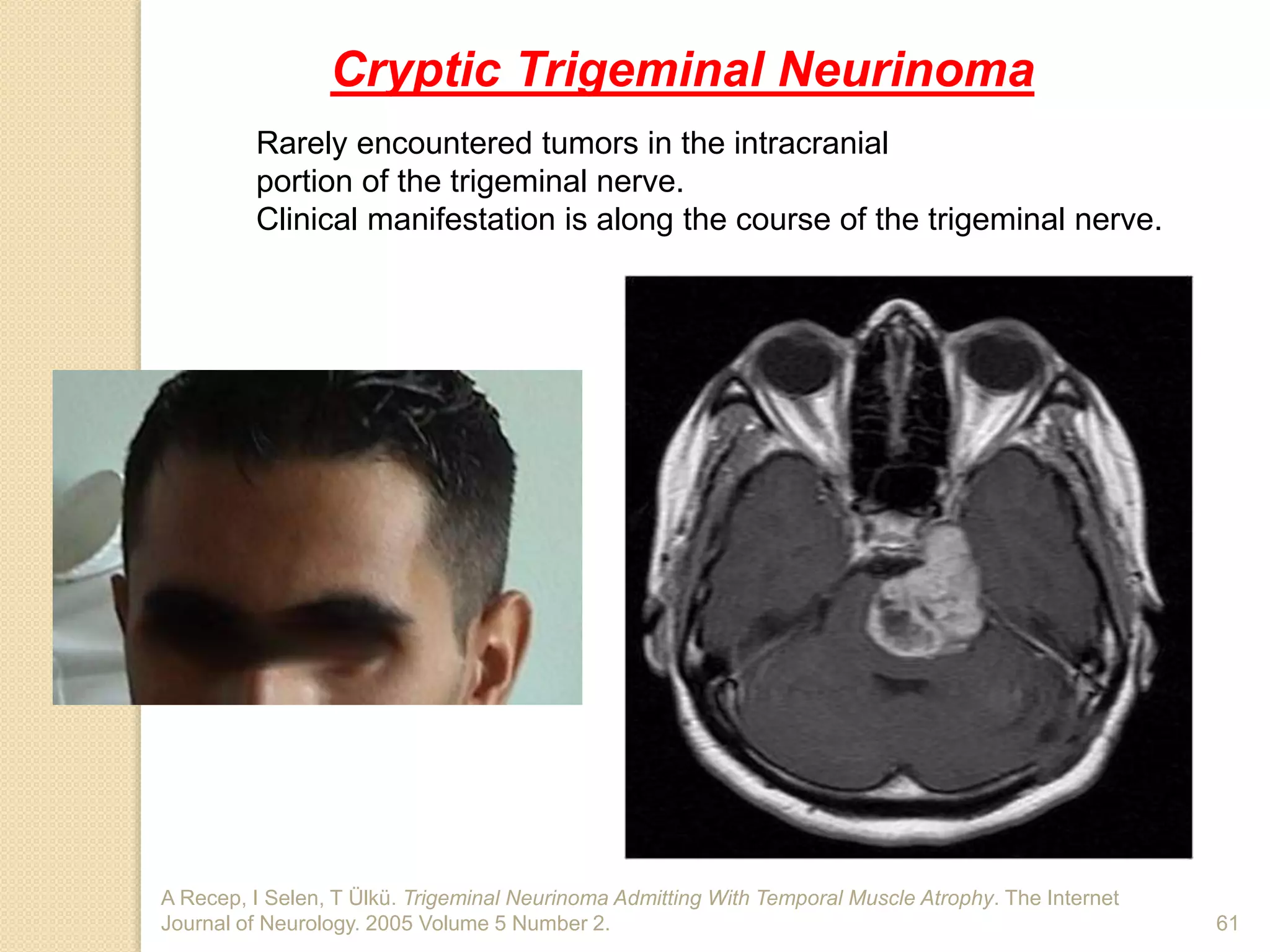 A Recep, I Selen, T Ülkü. Trigeminal Neurinoma Admitting With Temporal Muscle Atrophy. The Internet
Journal of Neurology. 2005 Volume 5 Number 2. 61
Cryptic Trigeminal Neurinoma
Rarely encountered tumors in the intracranial
portion of the trigeminal nerve.
Clinical manifestation is along the course of the trigeminal nerve.
 