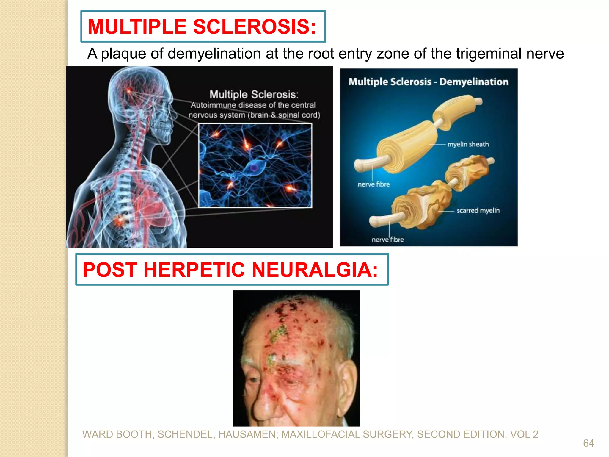 WARD BOOTH, SCHENDEL, HAUSAMEN; MAXILLOFACIAL SURGERY, SECOND EDITION, VOL 2
64
MULTIPLE SCLEROSIS:
A plaque of demyelination at the root entry zone of the trigeminal nerve
POST HERPETIC NEURALGIA:
 