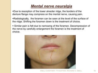 58
Mental nerve neuralgia
Due to resorption of the lower alveolar ridge, the borders of the
denture flange may compress on the mental nerve, causing pain.
Radiologically, the foramen can be seen at the level of the surface of
the ridge. Shifting the foramen down is the treatment of choice.
 Similar pain is felt due to narrowing of the foramen. Decompression of
the nerve by carefully enlargement the foramen is the treatment of
choice.
SNELL’S ANATOMY, 7TH EDITION, RICHARD S. SNELL.
 