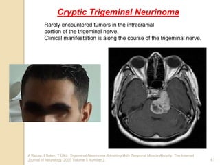 A Recep, I Selen, T Ülkü. Trigeminal Neurinoma Admitting With Temporal Muscle Atrophy. The Internet
Journal of Neurology. 2005 Volume 5 Number 2. 61
Cryptic Trigeminal Neurinoma
Rarely encountered tumors in the intracranial
portion of the trigeminal nerve.
Clinical manifestation is along the course of the trigeminal nerve.
 