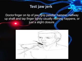 Doctor finger on tip of jaw, grip patellar hammer halfway
up shaft and tap finger lightly usually nothing happens, or
just a slight closure.
 