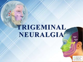 TRIGEMINAL
NEURALGIA
 