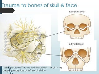 Trauma to bones of skull & face
malar fractures-Trauma to infraorbital margin may
cause sensory loss of infraorbital skin.
 