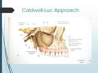 Caldwell-Luc Approach:
 