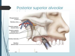 Posterior superior alveolar
block:
 