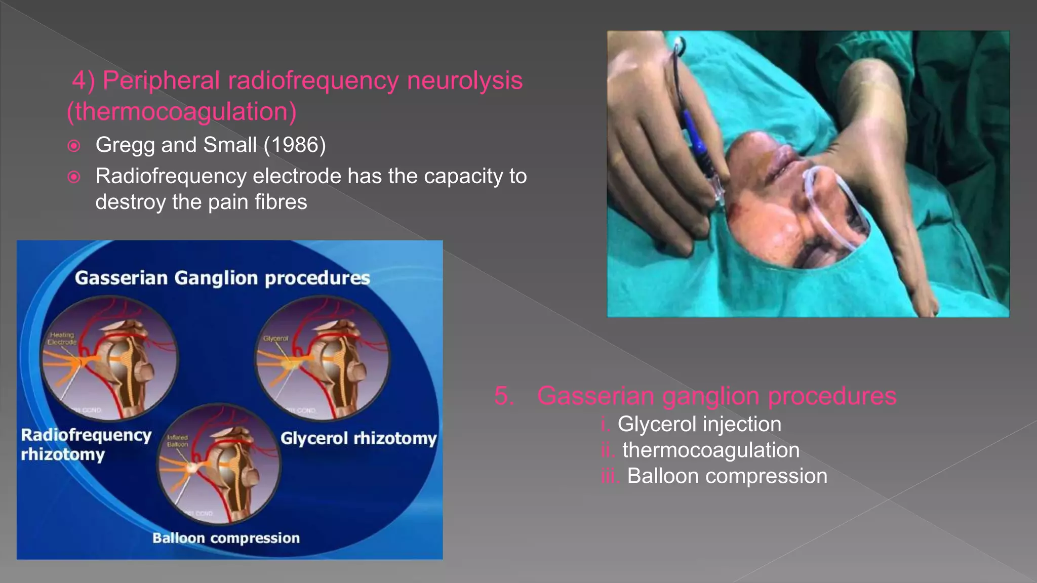 4) Peripheral radiofrequency neurolysis
(thermocoagulation)
 Gregg and Small (1986)
 Radiofrequency electrode has the capacity to
destroy the pain fibres
5. Gasserian ganglion procedures
i. Glycerol injection
ii. thermocoagulation
iii. Balloon compression
 