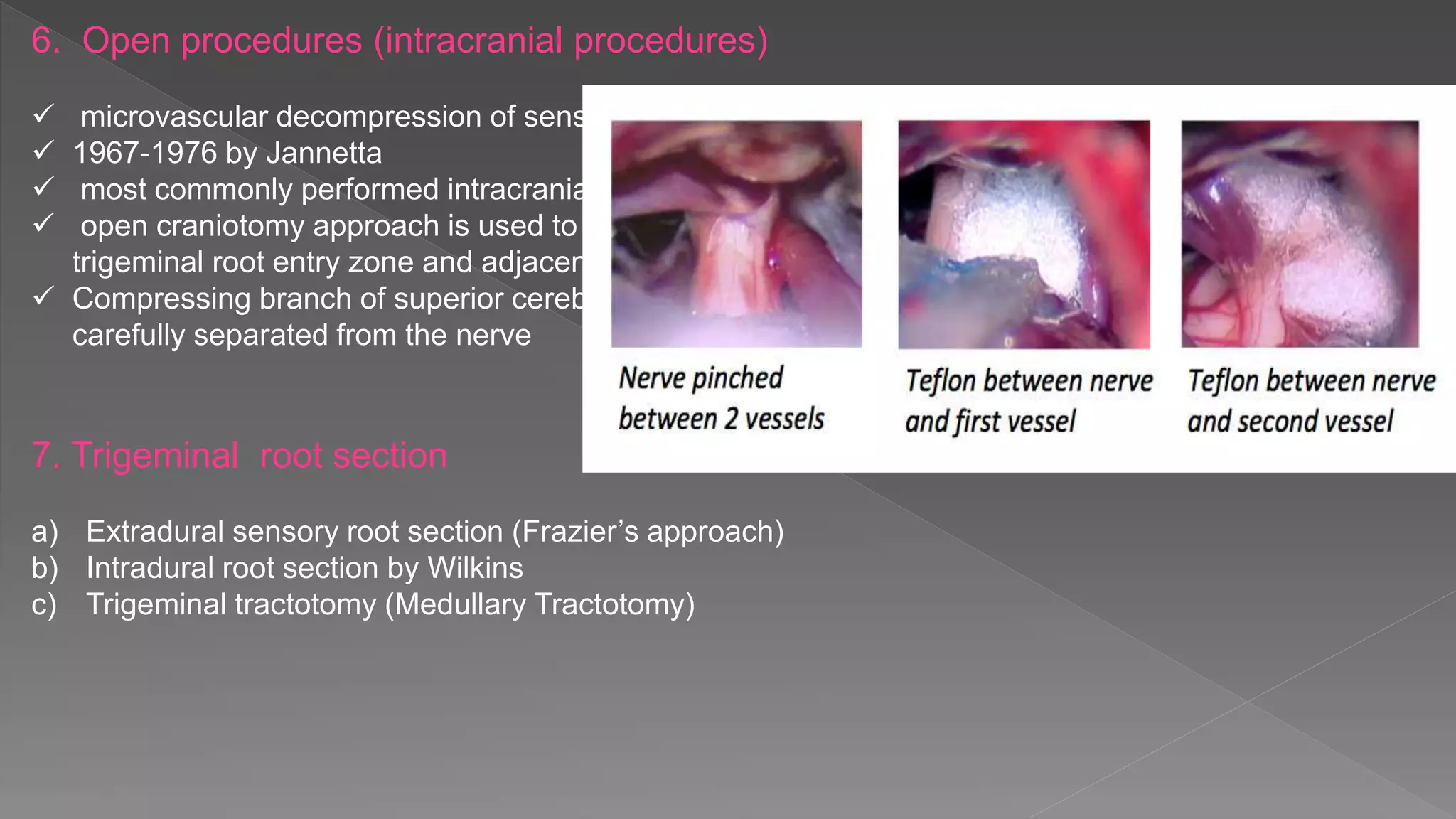 6. Open procedures (intracranial procedures)
 microvascular decompression of sensory root
 1967-1976 by Jannetta
 most commonly performed intracranial open procedure
 open craniotomy approach is used to gain access to the
trigeminal root entry zone and adjacent brain stem
 Compressing branch of superior cerebellar artery is
carefully separated from the nerve
7. Trigeminal root section
a) Extradural sensory root section (Frazier’s approach)
b) Intradural root section by Wilkins
c) Trigeminal tractotomy (Medullary Tractotomy)
 