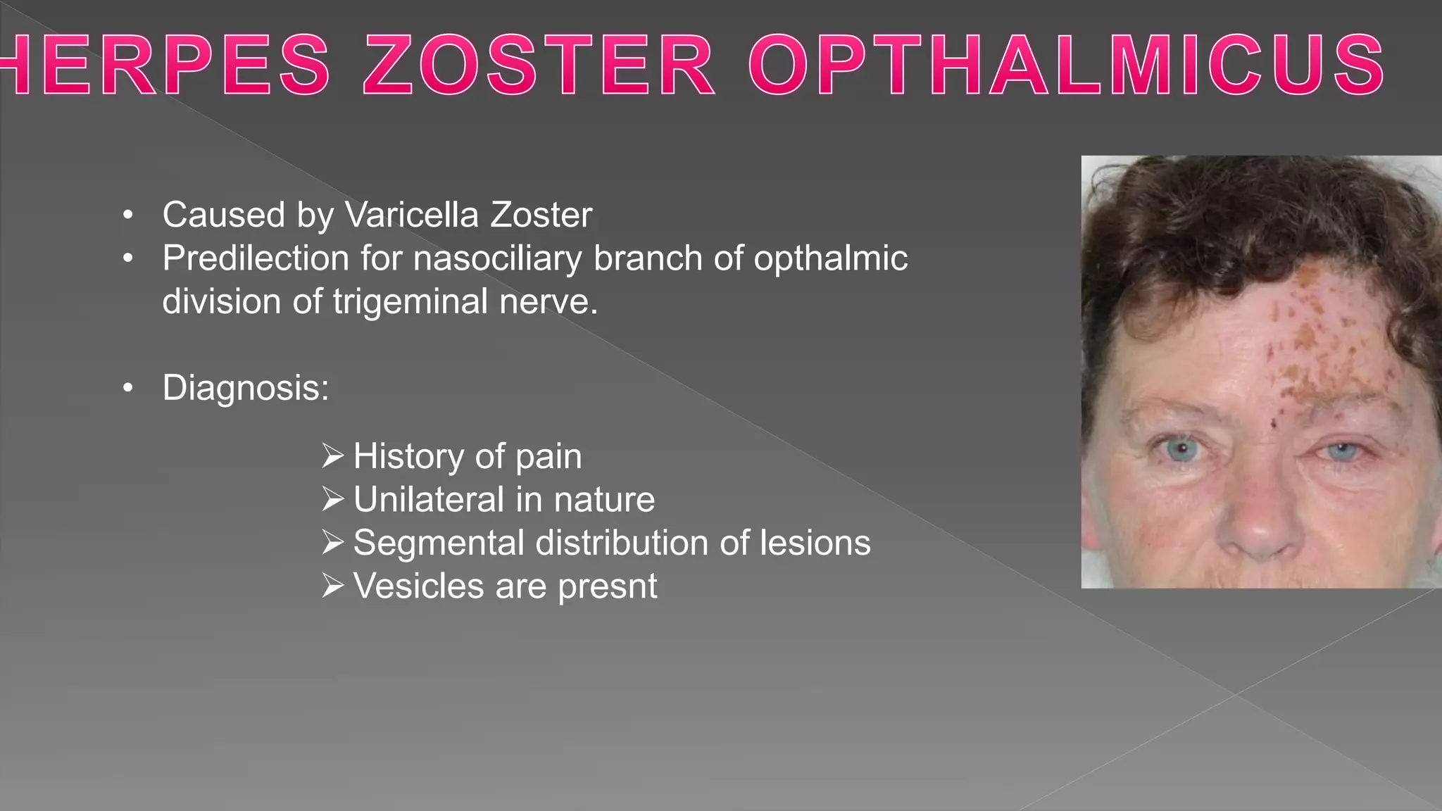 • Caused by Varicella Zoster
• Predilection for nasociliary branch of opthalmic
division of trigeminal nerve.
• Diagnosis:
History of pain
Unilateral in nature
Segmental distribution of lesions
Vesicles are presnt
 