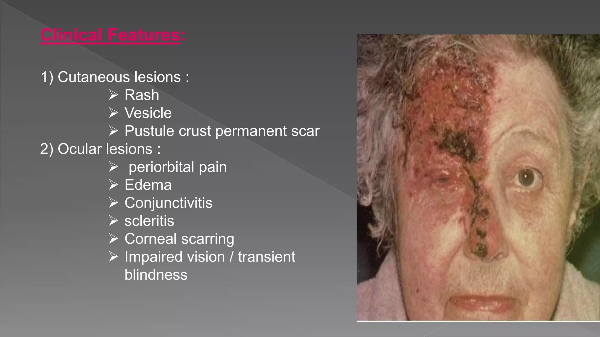 Clinical Features:
1) Cutaneous lesions :
 Rash
 Vesicle
 Pustule crust permanent scar
2) Ocular lesions :
 periorbital pain
 Edema
 Conjunctivitis
 scleritis
 Corneal scarring
 Impaired vision / transient
blindness
 
