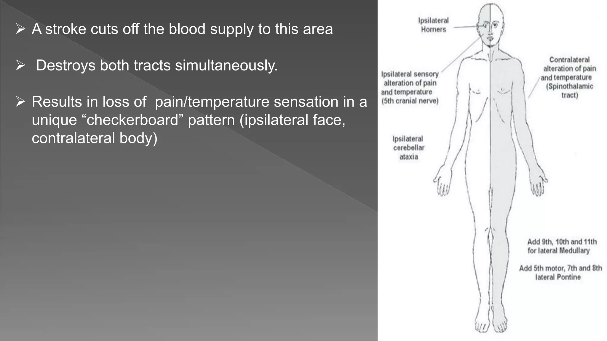 A stroke cuts off the blood supply to this area
 Destroys both tracts simultaneously.
 Results in loss of pain/temperature sensation in a
unique “checkerboard” pattern (ipsilateral face,
contralateral body)
 