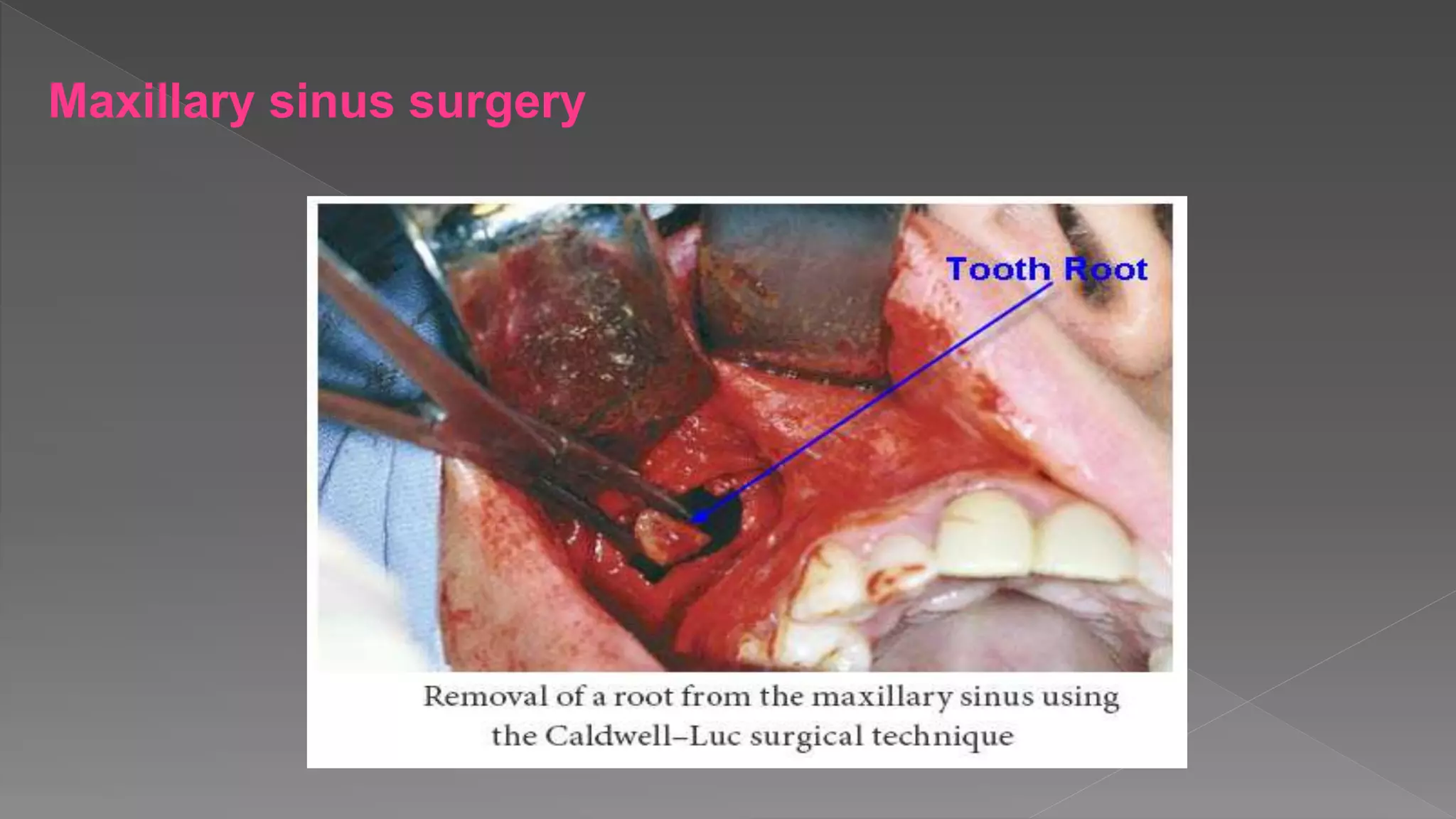 Maxillary sinus surgery
 