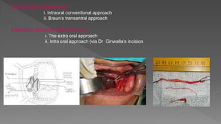 Infraorbital neurectomy
i. Intraoral conventional approach
ii. Braun’s transantral approach
Inferiorior Alveolar Neuractomy
i. The extra oral approach
ii. Intra oral approach (via Dr Ginwalla’s incision
 