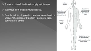  A stroke cuts off the blood supply to this area
 Destroys both tracts simultaneously.
 Results in loss of pain/temperature sensation in a
unique “checkerboard” pattern (ipsilateral face,
contralateral body)
 
