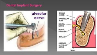 Dental Implant Surgery
 