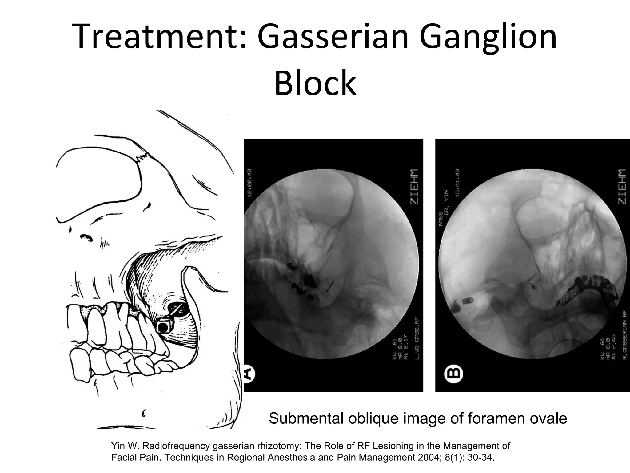Treatment: Gasserian Ganglion Block Submental oblique image of foramen ovale Yin W. Radiofrequency gasserian rhizotomy: The Role of RF Lesioning in the Management of Facial Pain. Techniques in Regional Anesthesia and Pain Management 2004; 8(1): 30-34.  