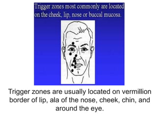 Trigger zones are usually located on vermillion
border of lip, ala of the nose, cheek, chin, and
around the eye.
 