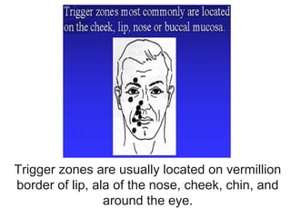 Trigger zones are usually located on vermillion
border of lip, ala of the nose, cheek, chin, and
around the eye.

 