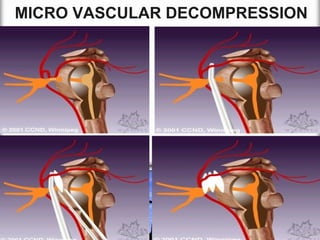 MICRO VASCULAR DECOMPRESSION

 