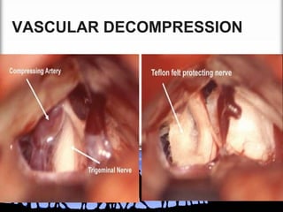 VASCULAR DECOMPRESSION

 