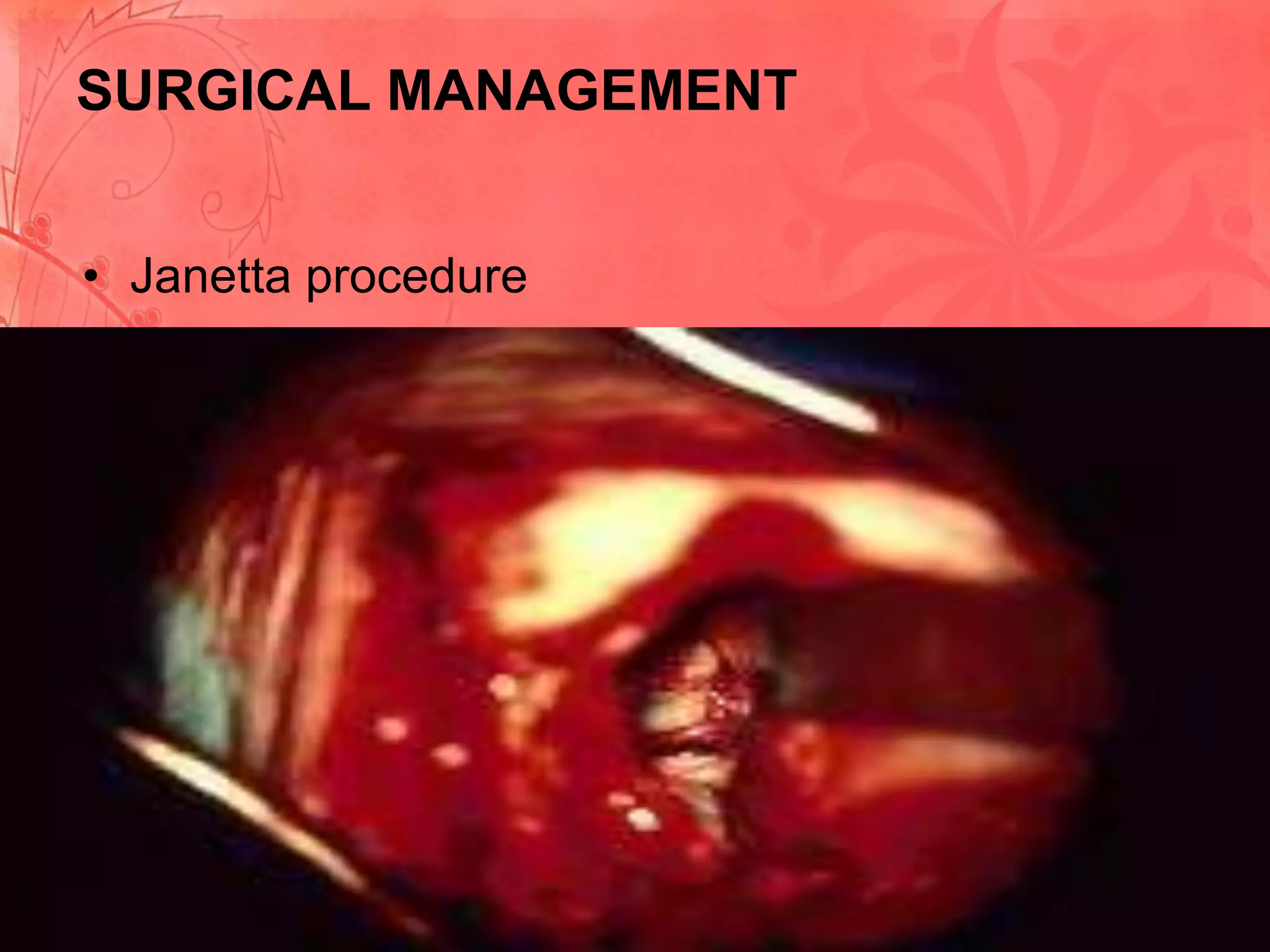 SURGICAL MANAGEMENT
• Janetta procedure

 