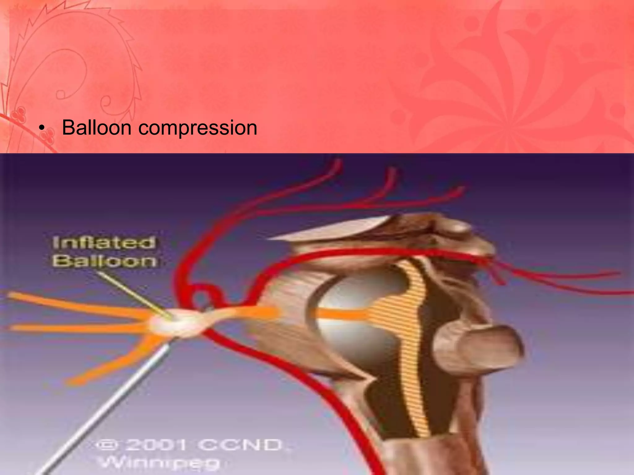 • Balloon compression

 