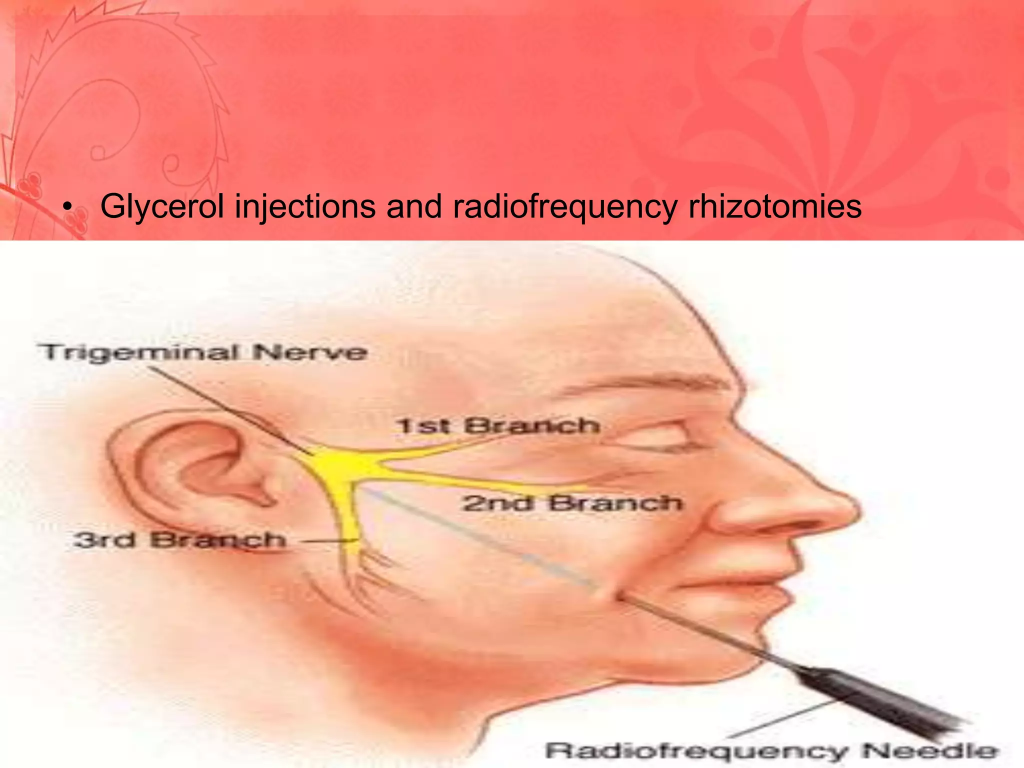 • Glycerol injections and radiofrequency rhizotomies

 