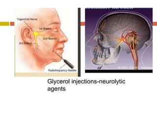 Glycerol injections-neurolytic
agents
 
