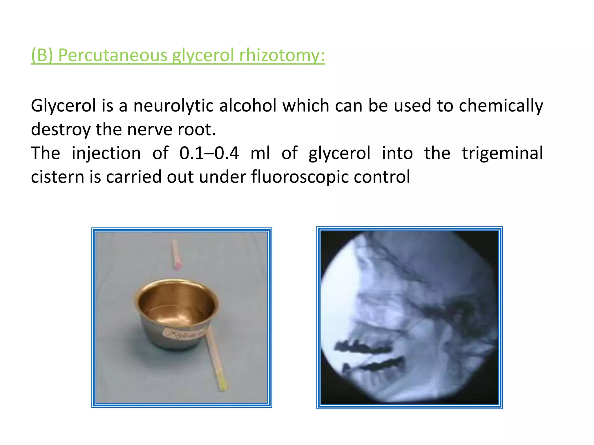 Trigeminal neuralgia in OMFS | PPT